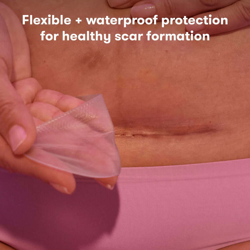 Frida Mom C-Section silicone strips - resusable medical grade treatment for keloid scars