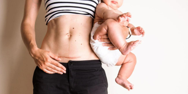Tips for Healing Abdominal Separation Post-Pregnancy